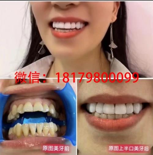 完美大使美牙多少錢做一次,項目靠不靠譜