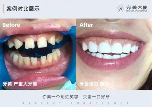 完美大使美牙多少錢做一次,項目靠不靠譜