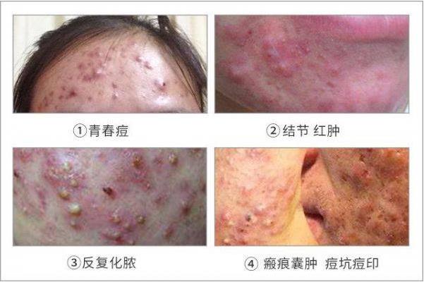 wro蛇床子洗面奶孕婦可以用嗎
