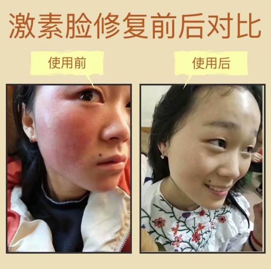 激素臉越來越嚴(yán)重了怎么辦?調(diào)理激素臉的好方法【值得收藏】