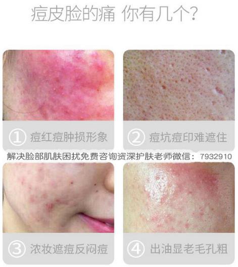過敏臉上起痘痘怎么辦?有人用朵嘉濃修復好的嗎?