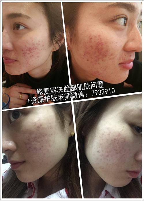 成激素臉了怎么辦?激素臉的解決方法你都知道嗎?