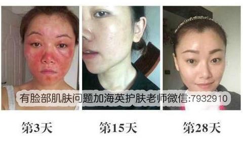 成激素臉了怎么辦?激素臉的解決方法你都知道嗎?