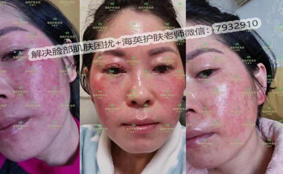 海英:激素臉是怎么形成的?激素臉怎么修復(fù)?激素臉的修復(fù)周期是多久?