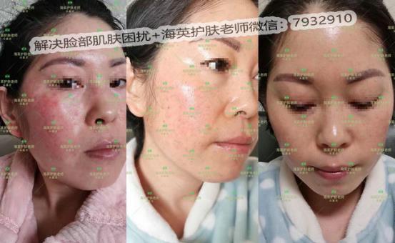 海英:激素臉是怎么形成的?激素臉怎么修復(fù)?激素臉的修復(fù)周期是多久?