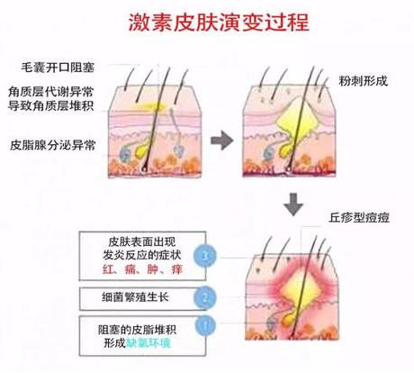 激素臉爆痘痘怎么辦?有什么辦法可以緩解?
