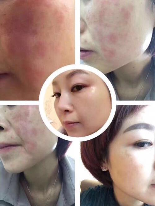 海英:激素臉是怎么形成的?激素臉怎么修復(fù)?激素臉的修復(fù)周期是多久?