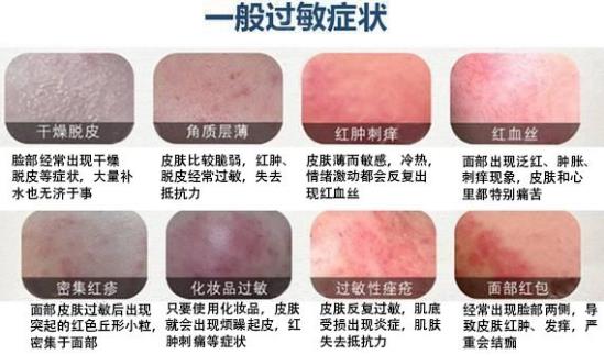 臉過敏癥狀有哪些?臉上過敏發(fā)紅發(fā)癢怎么辦?