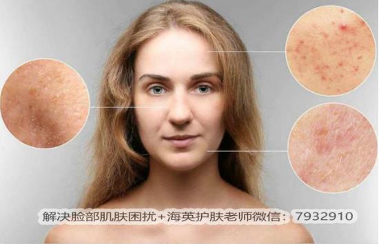 臉過敏癥狀有哪些?臉上過敏發(fā)紅發(fā)癢怎么辦?
