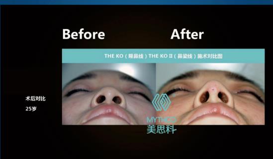 MYTHCO美思科線雕效果怎么樣?跟美思科蛋白線有什么區(qū)別?