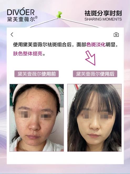 黛芙壹薇爾(divoer)祛斑效果怎么樣?不愧是國家認(rèn)證的祛斑組合