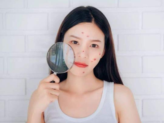 為什么打完九價會長痘?美國治療青春痘的新藥上市了嗎