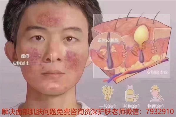 男生長痘痘怎么辦?男生祛痘選朵嘉濃護膚合適嗎?