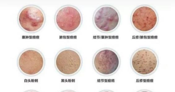 祛痘產品哪個好?朵嘉濃護膚品是專業(yè)祛痘必不可少的法寶
