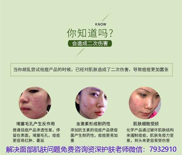祛痘護(hù)膚有什么比較好的產(chǎn)品推薦?朵嘉濃祛痘凝膠