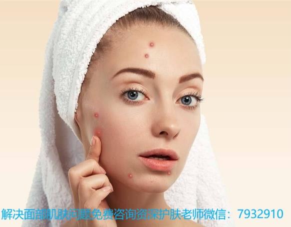 祛除痘印的方法哪個(gè)好?有了朵嘉濃祛除痘印痘坑不再是妄想