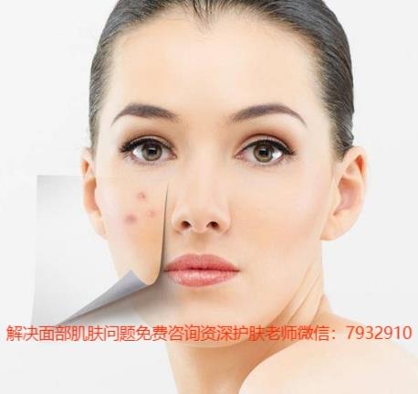 祛除痘印的方法哪個(gè)好?有了朵嘉濃祛除痘印痘坑不再是妄想
