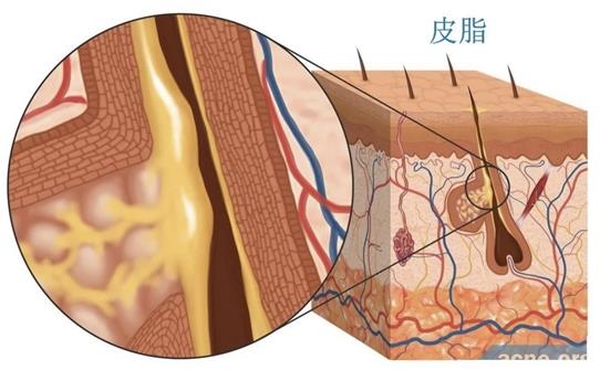 朵嘉濃祛痘凝膠快速祛痘,祛痘新方法真不賴