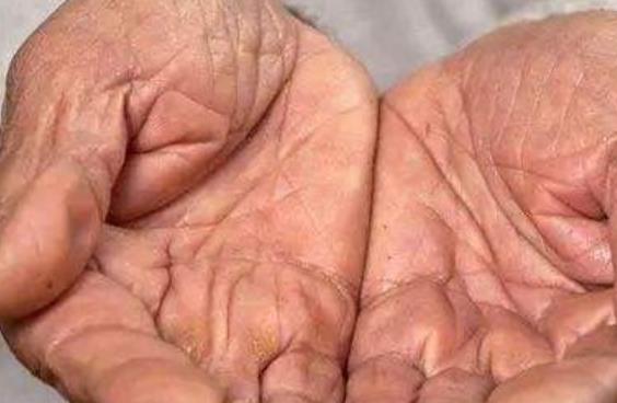 手部脫皮很難看 介紹改善手部脫皮的6個(gè)妙方