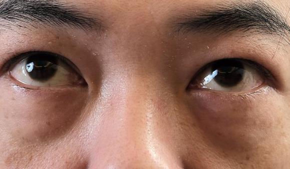 男性要護膚 多照顧眼部肌膚