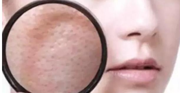 臉上毛孔粗大看起來(lái)皮膚就很不好 7大因素造成毛孔粗大