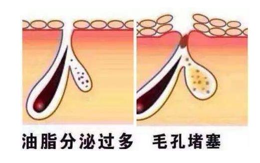 毛孔粗大用食鹽有用嗎 毛孔粗大的4大護理誤區(qū)