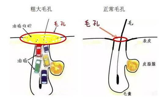 毛孔粗大用食鹽有用嗎 毛孔粗大的4大護理誤區(qū)