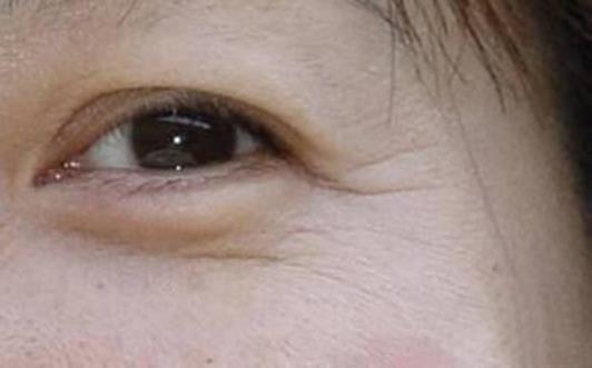 如何去眼袋有效 為你消除眼袋肌膚問題