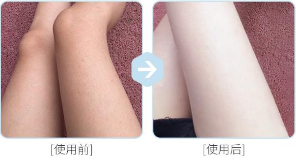 腿上雞皮膚嚴(yán)重怎么弄,最有效方法解您雞皮膚困擾