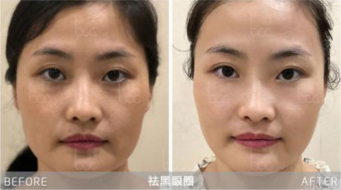 黎京雄院長提醒你:別以為黑眼圈只是熬夜的錯