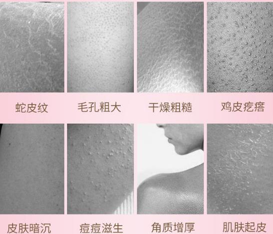 去雞皮膚最有效的藥膏 快速去雞皮膚退出膚愁者聯(lián)盟