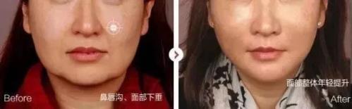 香蜜麗格【笑是原罪?】20歲就有法令紋了?難道是我老了嗎?