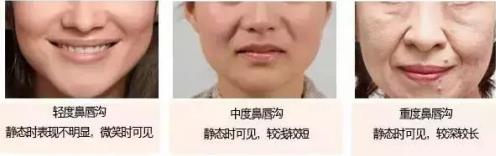 香蜜麗格【笑是原罪?】20歲就有法令紋了?難道是我老了嗎?