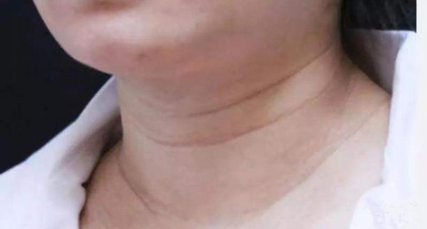 重塑天鵝頸,守住優(yōu)雅的最后一道防線