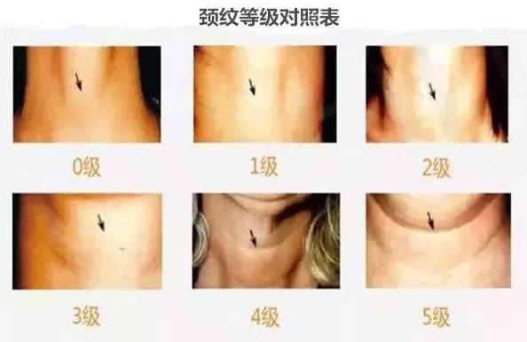 重塑天鵝頸,守住優(yōu)雅的最后一道防線