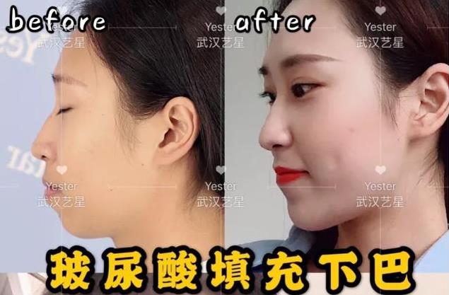 武漢玻尿酸價(jià)格多少一支?武漢藝星整形醫(yī)院年中大促,超值低價(jià)!