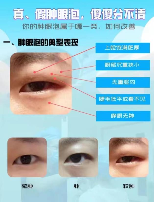 【寧波卓美】雙眼皮是一個(gè)小手術(shù)嗎?失誤真的很小嗎?