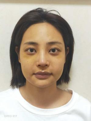 【寧波卓美】你后悔做隆鼻嗎?看完她做的鼻子····