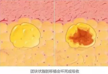 煙臺曙光整形醫(yī)院怎么樣?做自體脂肪豐胸,到底能不能一次成型? 圖片1111.png