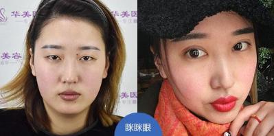 煙臺華美整形醫(yī)院開眼角手術(shù)安全嗎 追求高品質(zhì)、高度安全首選