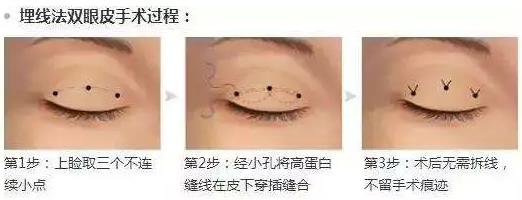 八大處楊欣教授:雙眼皮手術(shù)后需要多久才能恢復(fù)