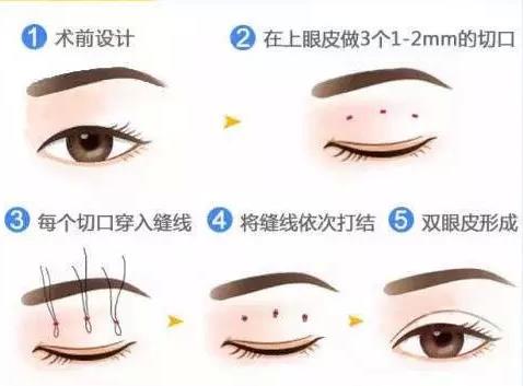 八大處楊欣教授:雙眼皮手術(shù)后需要多久才能恢復(fù)