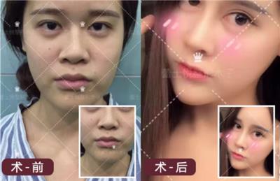 保妥適抗衰就選北京蕾士悅