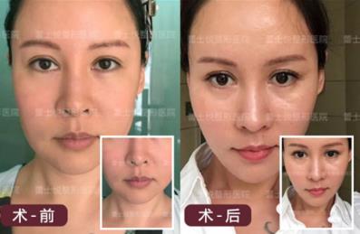 保妥適抗衰就選北京蕾士悅