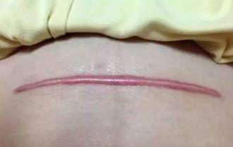 剖腹產疤痕為什么會發(fā)癢 重慶瑪恩皮膚祛疤分型治療