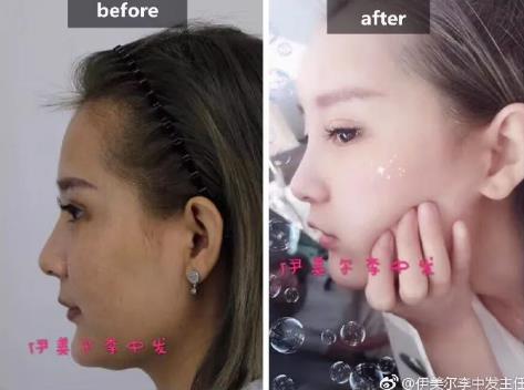 伊美爾愛康醫(yī)院自體脂肪填充效果好不好?