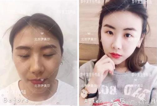 伊美爾愛康醫(yī)院自體脂肪填充效果好不好?