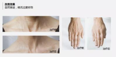 菲洛嘉價(jià)格貴不貴?北京伊美爾紫竹幫你恢復(fù)水潤(rùn)美白