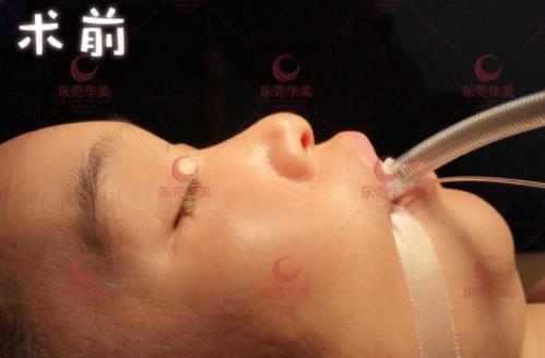 東莞華美醫(yī)療美容:首發(fā)ATR自體美雕鼻技術(shù),“0”距離專家面診