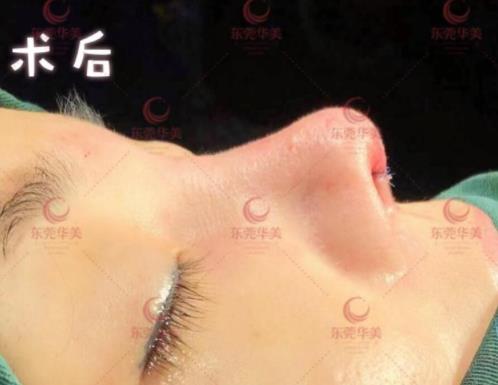 東莞華美醫(yī)療美容:首發(fā)ATR自體美雕鼻技術(shù),“0”距離專家面診